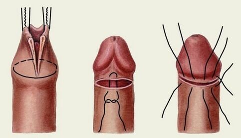 a essência da cirurgia de aumento do pênis