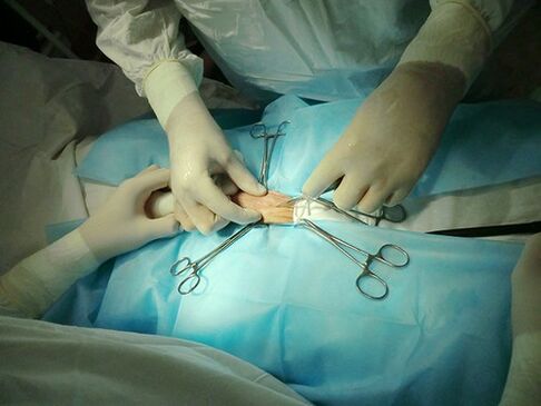 cirurgia de aumento do pênis
