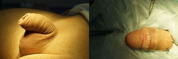 pênis antes e depois da cirurgia de aumento