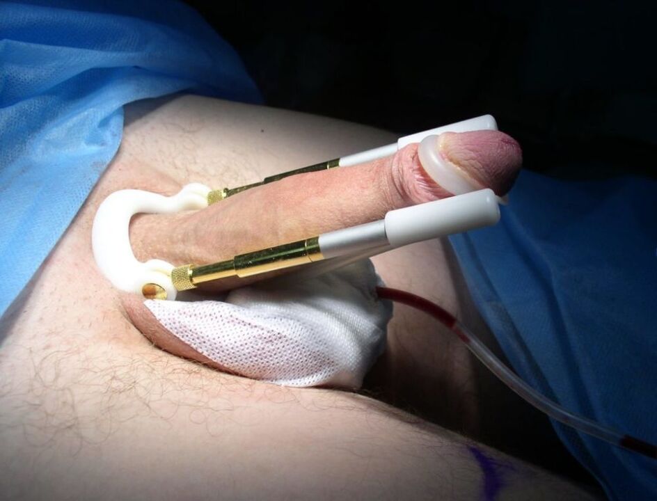 extensor após cirurgia de aumento do pênis