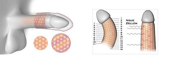 Resultado da cirurgia de aumento do pênis