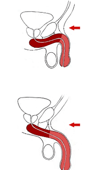 antes e depois da cirurgia de aumento do pênis