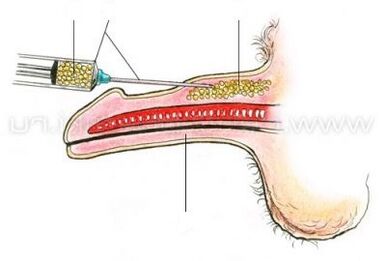 aumento do pênis por injeção