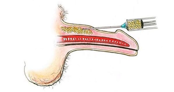 transplante de tecido muscular para aumento do pênis